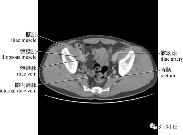 影像PPT - 46组对比图带你完全掌握腹部影像解剖-53 影像PPT - 46组对比图带你完全掌握腹部影像解剖-53