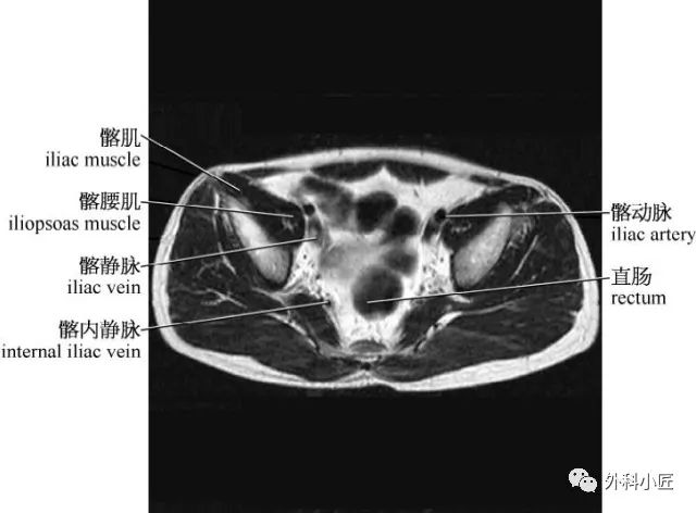 影像PPT - 46组对比图带你完全掌握腹部影像解剖-52 影像PPT - 46组对比图带你完全掌握腹部影像解剖-52