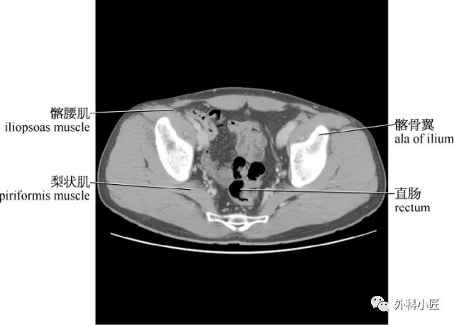 影像PPT - 46组对比图带你完全掌握腹部影像解剖-56 影像PPT - 46组对比图带你完全掌握腹部影像解剖-56