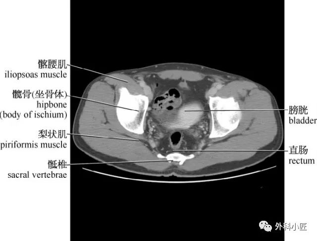 影像PPT - 46组对比图带你完全掌握腹部影像解剖-62 影像PPT - 46组对比图带你完全掌握腹部影像解剖-62