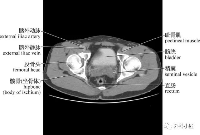 影像PPT - 46组对比图带你完全掌握腹部影像解剖-72 影像PPT - 46组对比图带你完全掌握腹部影像解剖-72