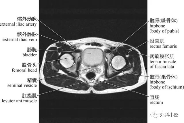 影像PPT - 46组对比图带你完全掌握腹部影像解剖-74 影像PPT - 46组对比图带你完全掌握腹部影像解剖-74