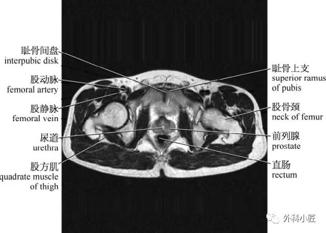 影像PPT - 46组对比图带你完全掌握腹部影像解剖-80 影像PPT - 46组对比图带你完全掌握腹部影像解剖-80