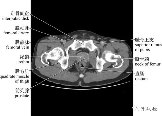 影像PPT - 46组对比图带你完全掌握腹部影像解剖-81 影像PPT - 46组对比图带你完全掌握腹部影像解剖-81