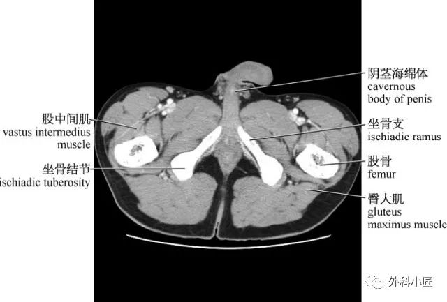 影像PPT - 46组对比图带你完全掌握腹部影像解剖-90 影像PPT - 46组对比图带你完全掌握腹部影像解剖-90