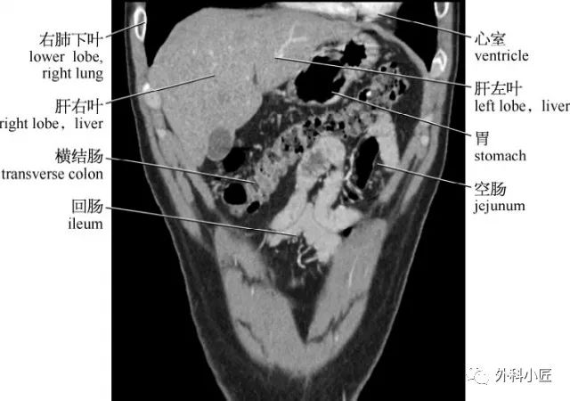 影像PPT - 46组对比图带你完全掌握腹部影像解剖-96 影像PPT - 46组对比图带你完全掌握腹部影像解剖-96