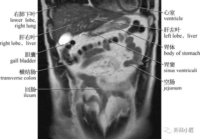 影像PPT - 46组对比图带你完全掌握腹部影像解剖-98 影像PPT - 46组对比图带你完全掌握腹部影像解剖-98