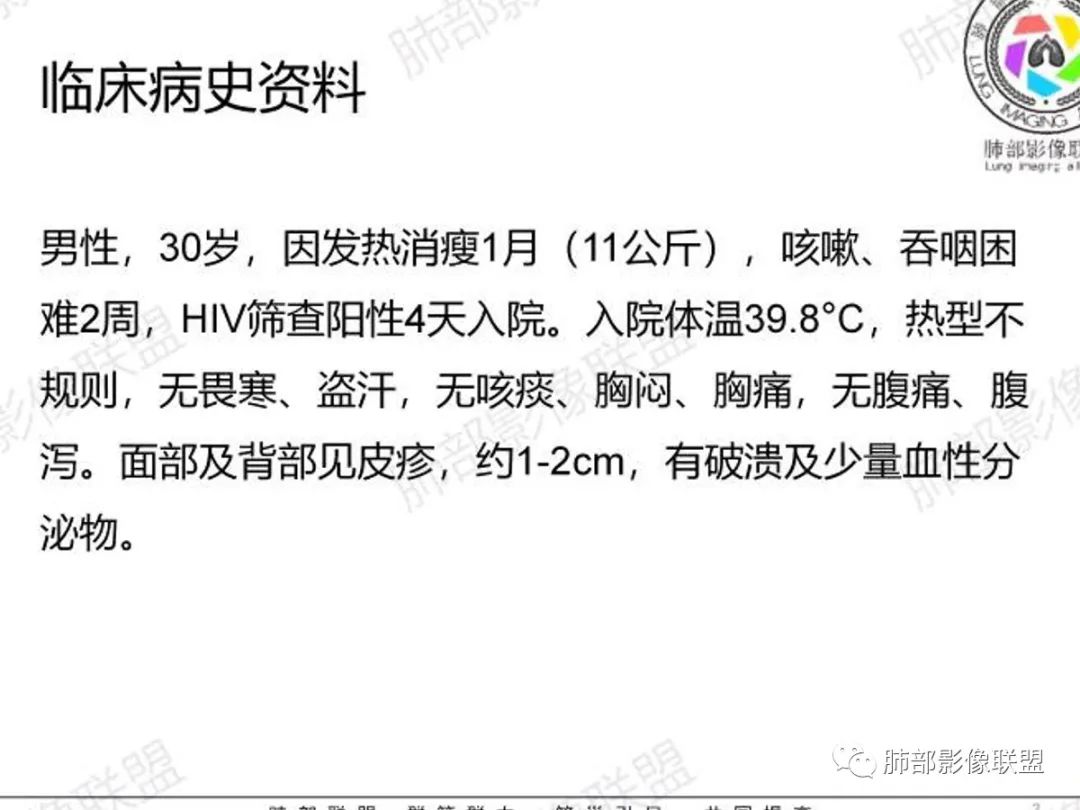 影像PPT - 【病例】马尔尼菲篮状菌感染1例CT影像-2 影像PPT - 【病例】马尔尼菲篮状菌感染1例CT影像-2