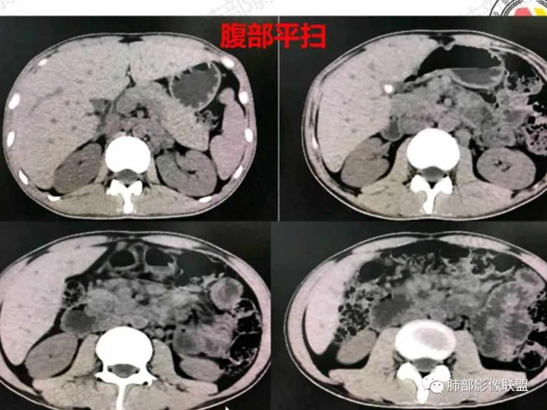 影像PPT - 【病例】马尔尼菲篮状菌感染1例CT影像-6 影像PPT - 【病例】马尔尼菲篮状菌感染1例CT影像-6