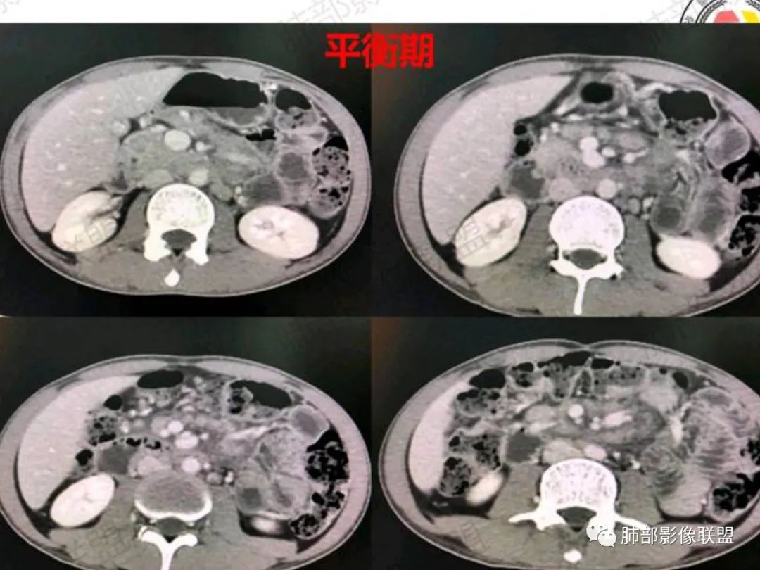 影像PPT - 【病例】马尔尼菲篮状菌感染1例CT影像-9 影像PPT - 【病例】马尔尼菲篮状菌感染1例CT影像-9