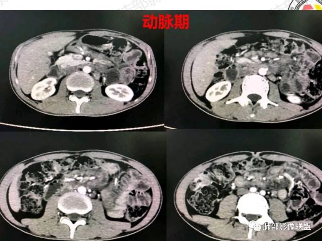 影像PPT - 【病例】马尔尼菲篮状菌感染1例CT影像-7 影像PPT - 【病例】马尔尼菲篮状菌感染1例CT影像-7