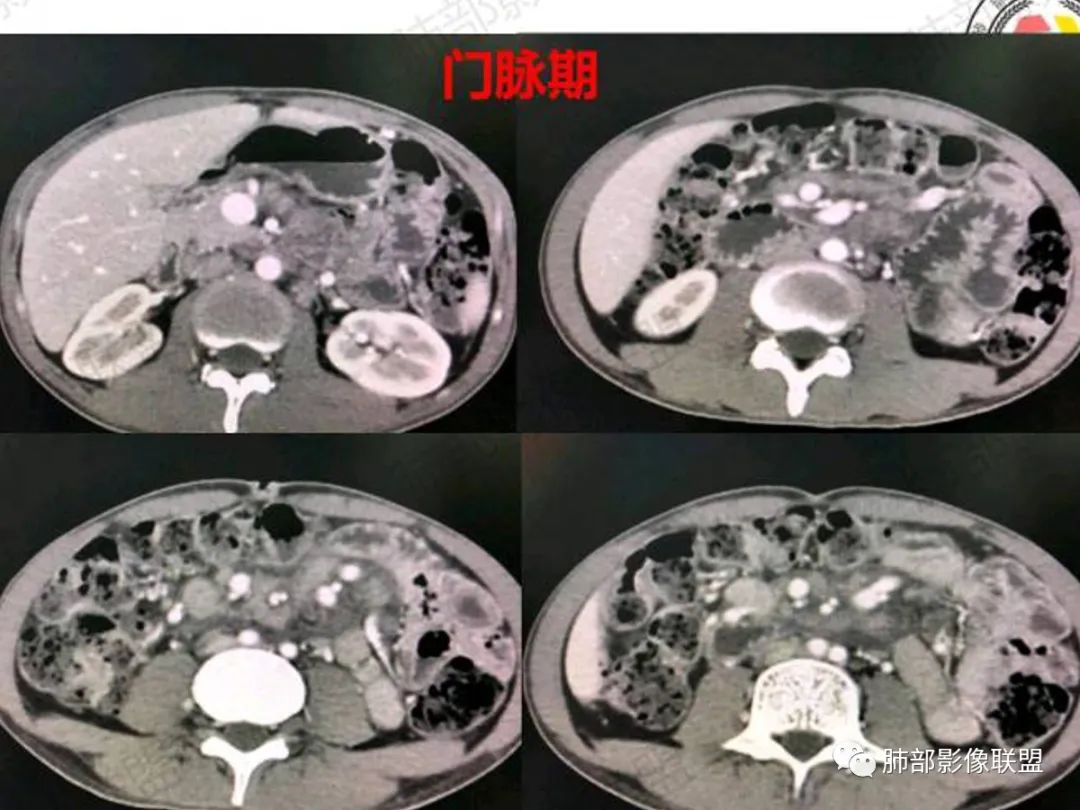影像PPT - 【病例】马尔尼菲篮状菌感染1例CT影像-8 影像PPT - 【病例】马尔尼菲篮状菌感染1例CT影像-8