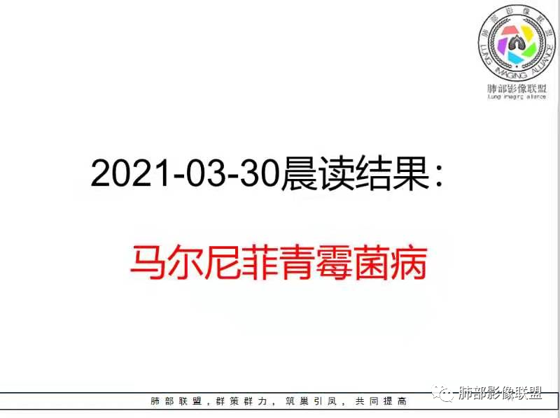 影像PPT - 【病例】马尔尼菲篮状菌感染1例CT影像-14 影像PPT - 【病例】马尔尼菲篮状菌感染1例CT影像-14