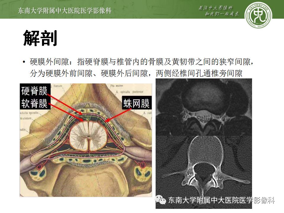 影像PPT - 【PPT】椎管内硬膜外脂肪增多症与终丝脂肪堆积-5