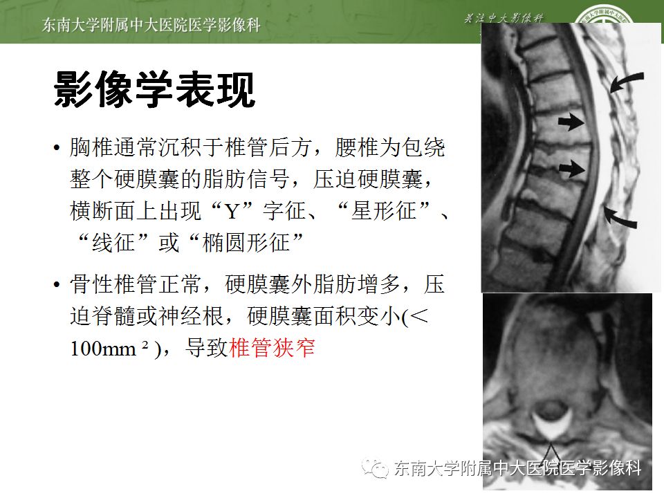影像PPT - 【PPT】椎管内硬膜外脂肪增多症与终丝脂肪堆积-9