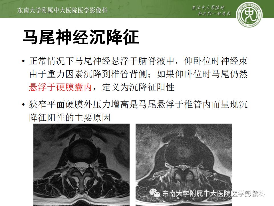 影像PPT - 【PPT】椎管内硬膜外脂肪增多症与终丝脂肪堆积-13