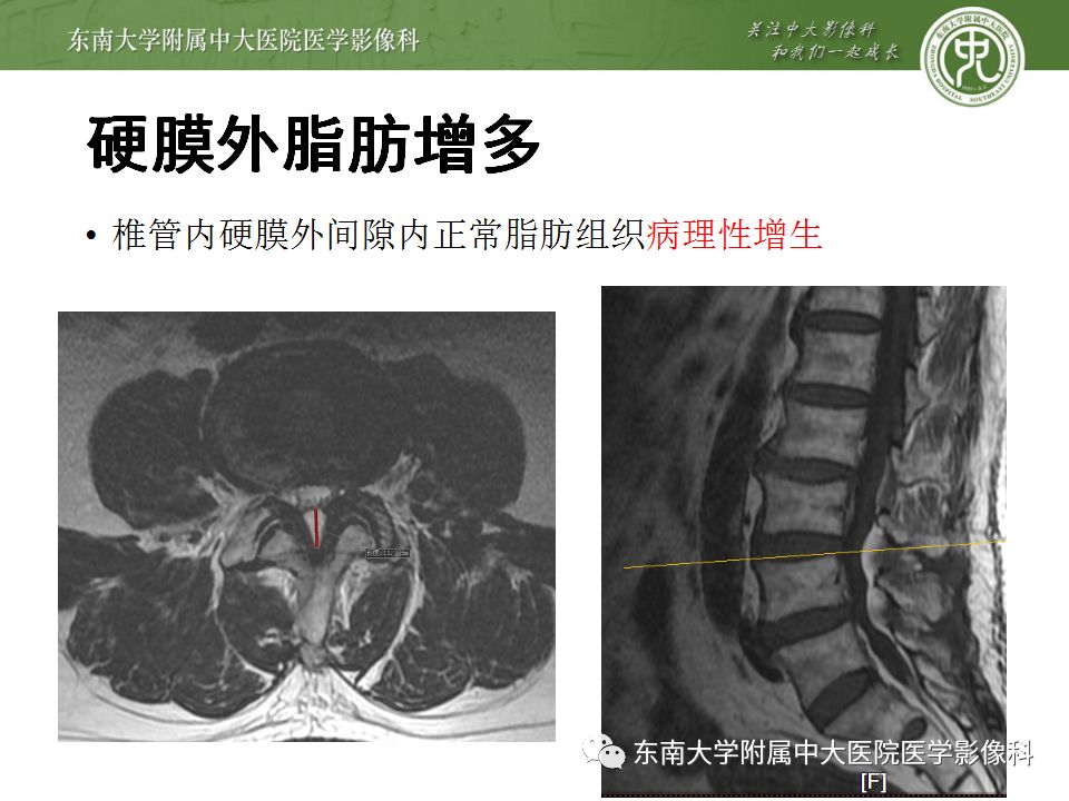 影像PPT - 【PPT】椎管内硬膜外脂肪增多症与终丝脂肪堆积-11