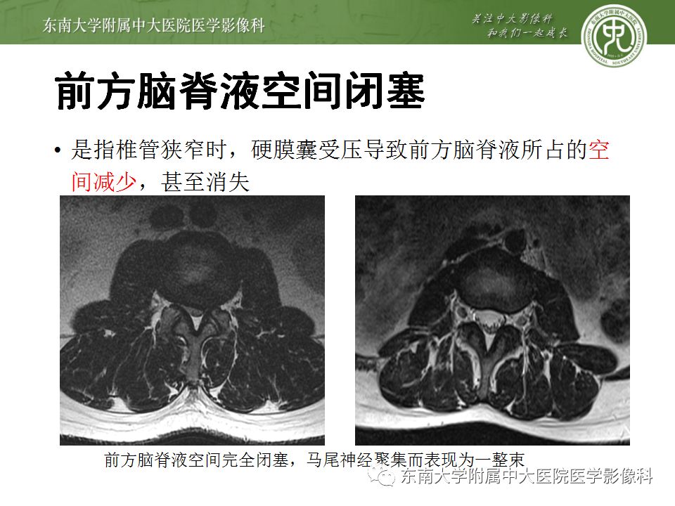 影像PPT - 【PPT】椎管内硬膜外脂肪增多症与终丝脂肪堆积-14