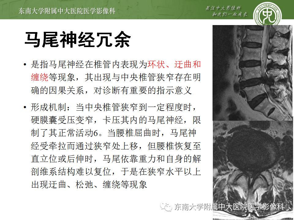 影像PPT - 【PPT】椎管内硬膜外脂肪增多症与终丝脂肪堆积-12