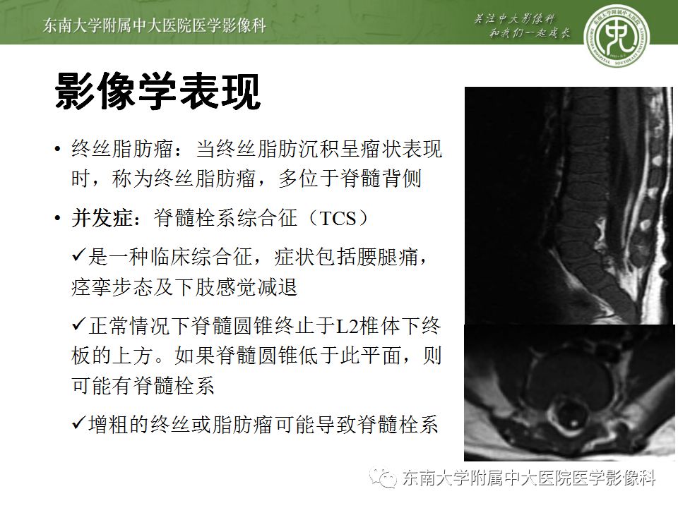 影像PPT - 【PPT】椎管内硬膜外脂肪增多症与终丝脂肪堆积-18