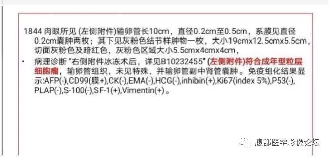 影像PPT - 【病例】卵巢成年型颗粒细胞瘤1例MR-4
