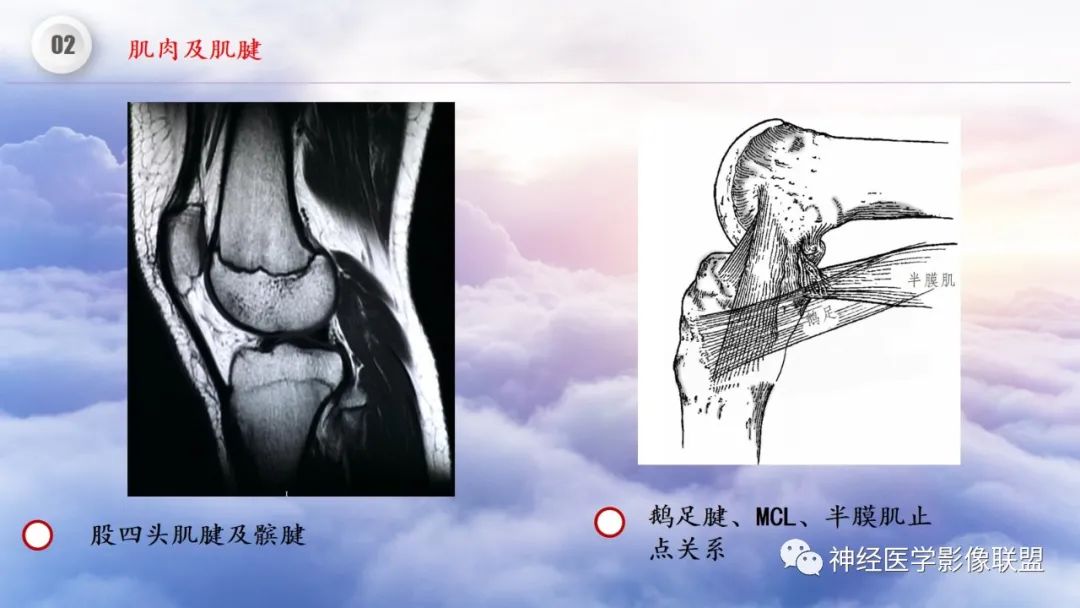 影像PPT - 【PPT】膝关节正常解剖及MR信号特点-33