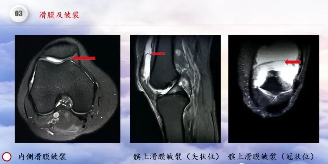 影像PPT - 【PPT】膝关节正常解剖及MR信号特点-38