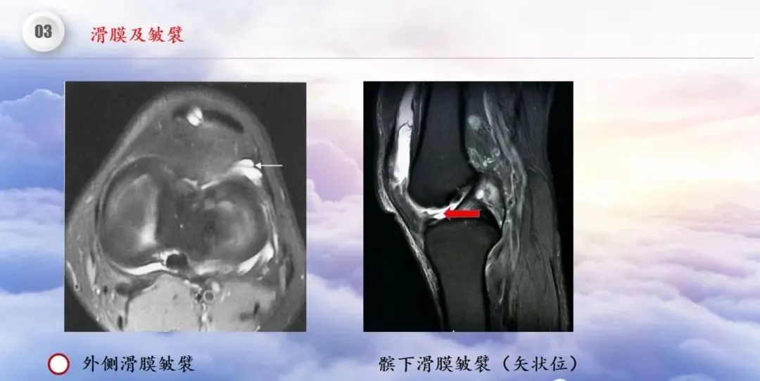 影像PPT - 【PPT】膝关节正常解剖及MR信号特点-39
