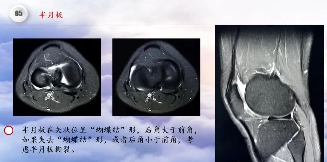 影像PPT - 【PPT】膝关节正常解剖及MR信号特点-44