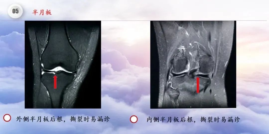 影像PPT - 【PPT】膝关节正常解剖及MR信号特点-45
