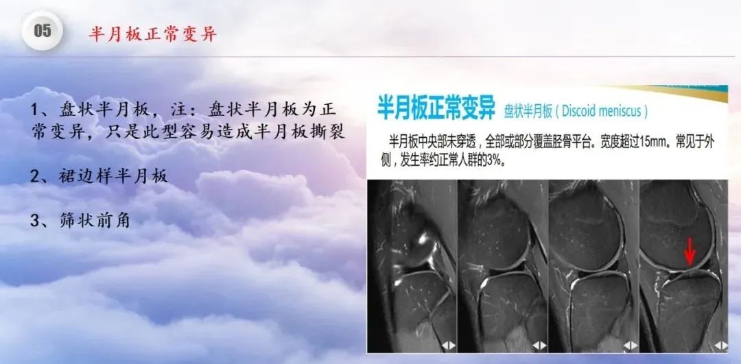 影像PPT - 【PPT】膝关节正常解剖及MR信号特点-46