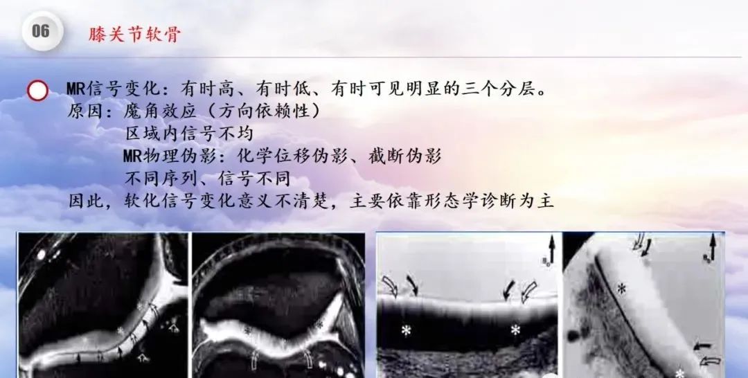影像PPT - 【PPT】膝关节正常解剖及MR信号特点-49