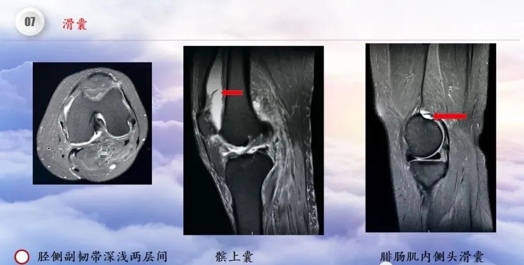 影像PPT - 【PPT】膝关节正常解剖及MR信号特点-55