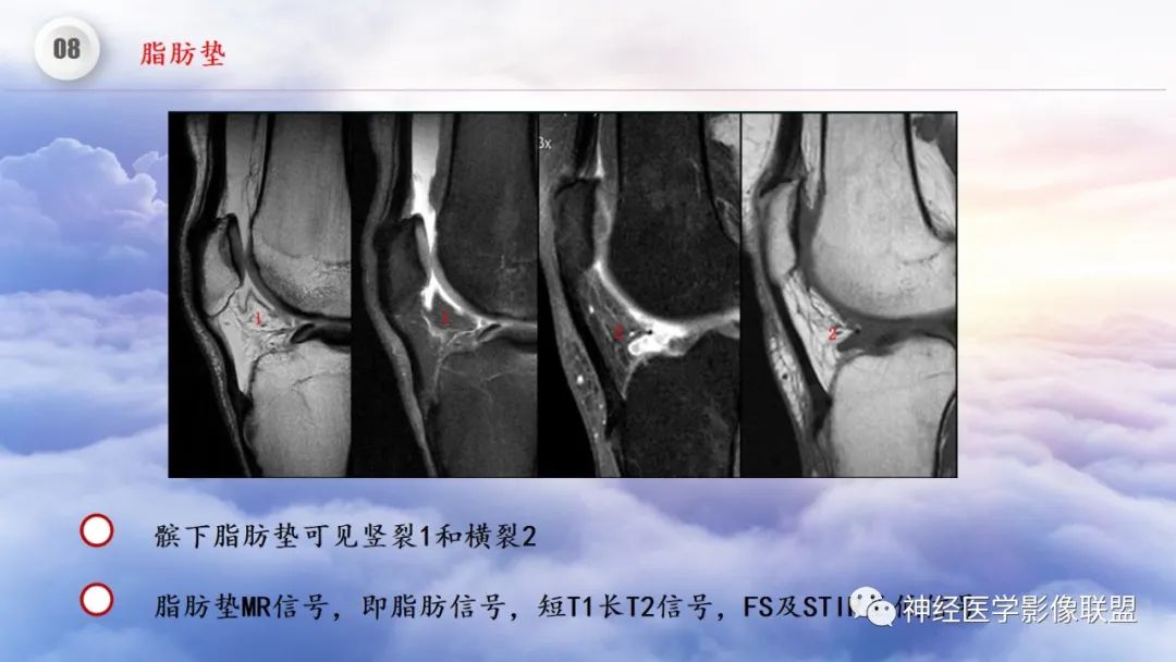 影像PPT - 【PPT】膝关节正常解剖及MR信号特点-57