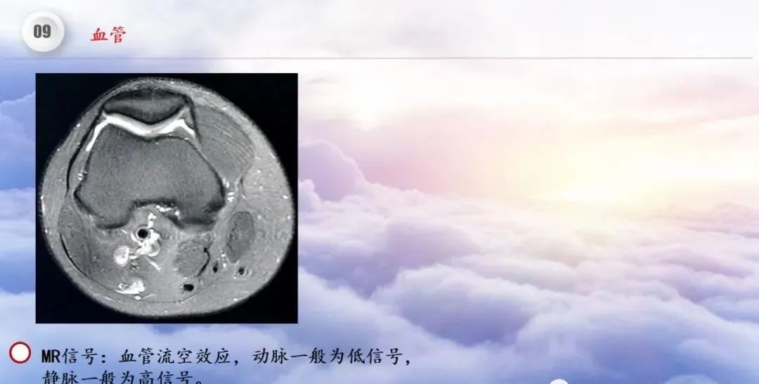影像PPT - 【PPT】膝关节正常解剖及MR信号特点-59