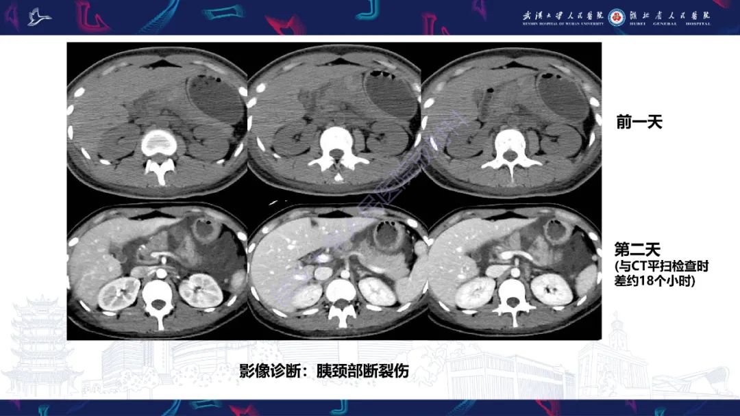 影像PPT - 【PPT】胰腺损伤影像诊断-3