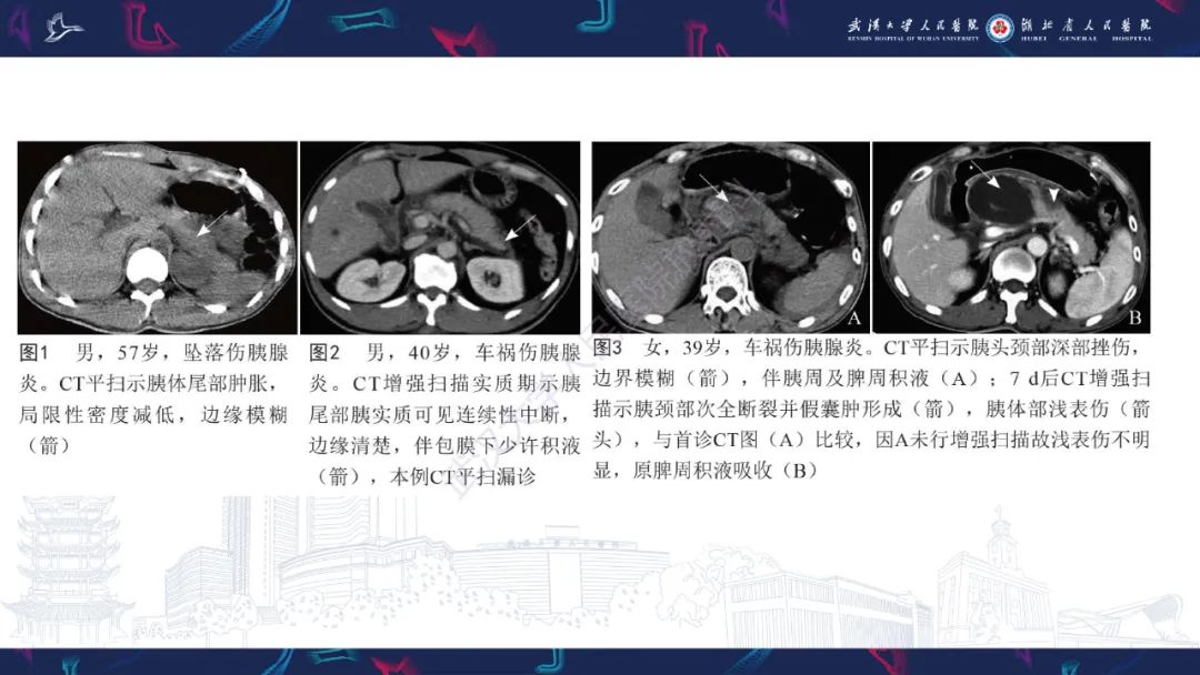 影像PPT - 【PPT】胰腺损伤影像诊断-16