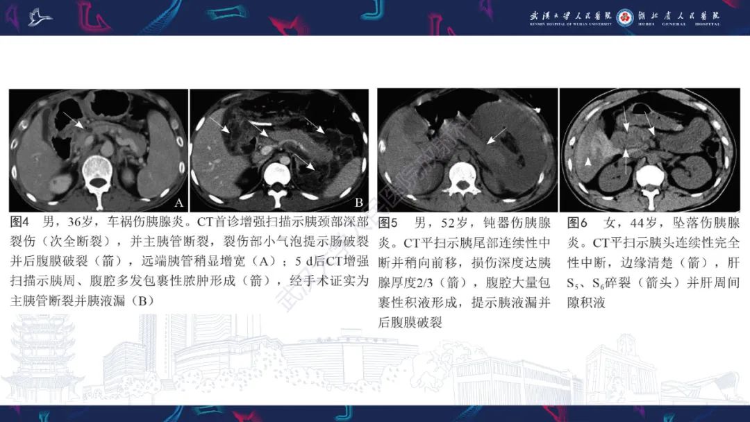 影像PPT - 【PPT】胰腺损伤影像诊断-17