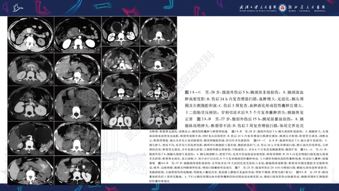 影像PPT - 【PPT】胰腺损伤影像诊断-18