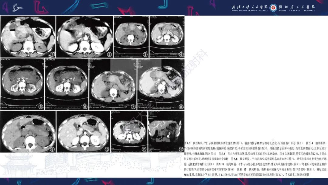 影像PPT - 【PPT】胰腺损伤影像诊断-19