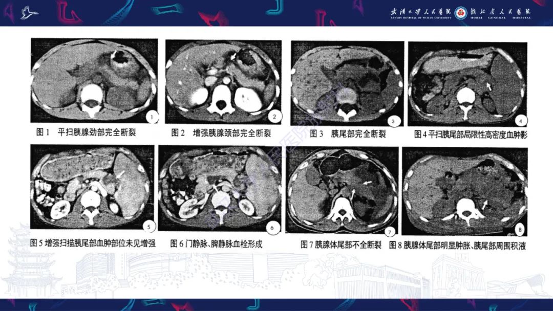 影像PPT - 【PPT】胰腺损伤影像诊断-20