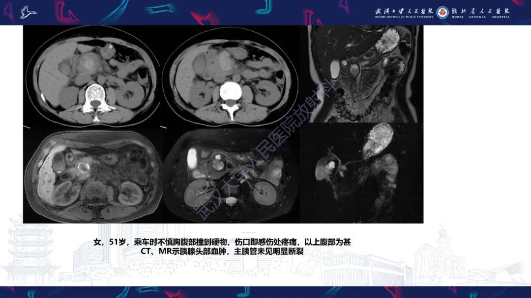 影像PPT - 【PPT】胰腺损伤影像诊断-21