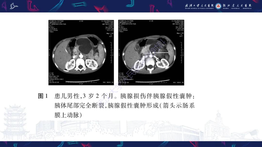 影像PPT - 【PPT】胰腺损伤影像诊断-23