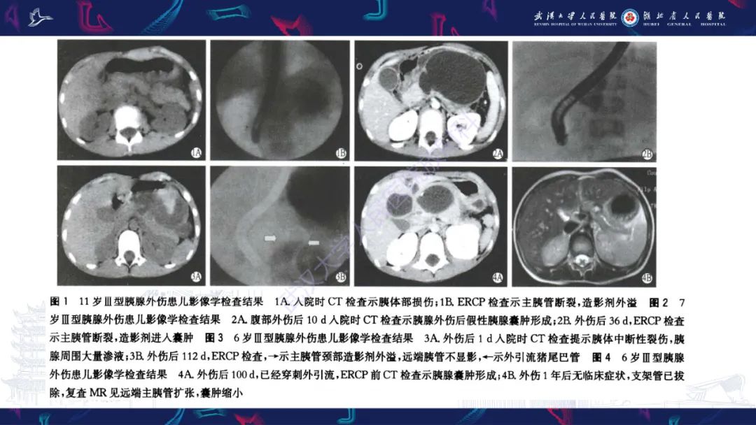 影像PPT - 【PPT】胰腺损伤影像诊断-24