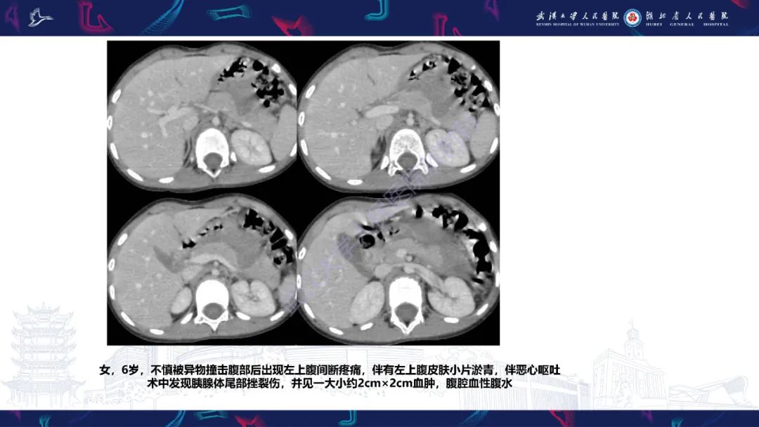 影像PPT - 【PPT】胰腺损伤影像诊断-26