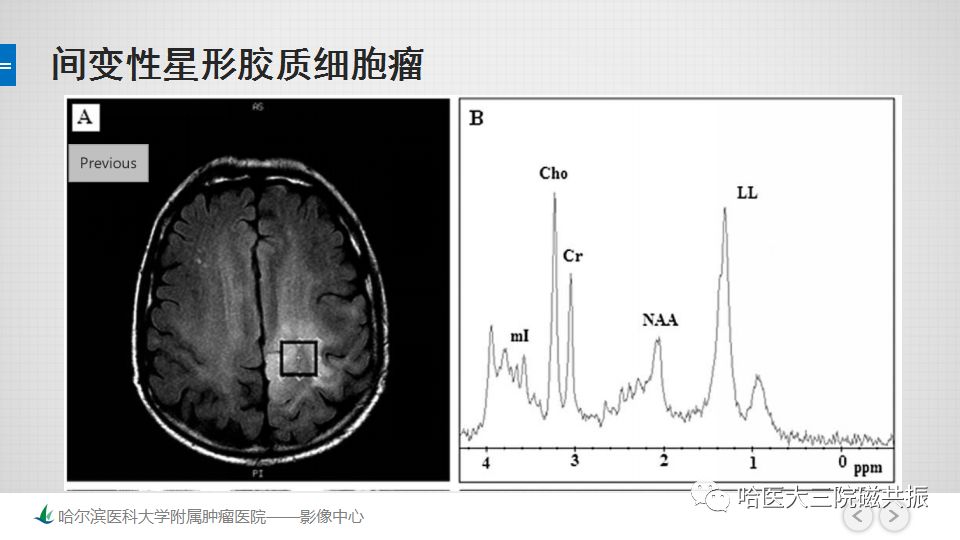 影像PPT - 【PPT】磁共振波谱（MRS）的那些事-30