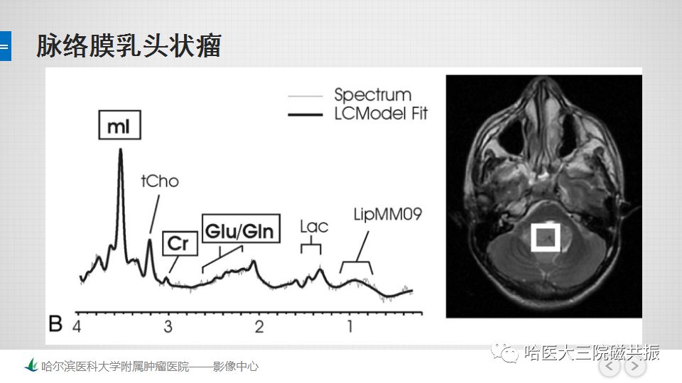 影像PPT - 【PPT】磁共振波谱（MRS）的那些事-32