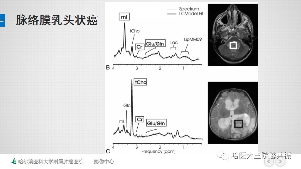 影像PPT - 【PPT】磁共振波谱（MRS）的那些事-33