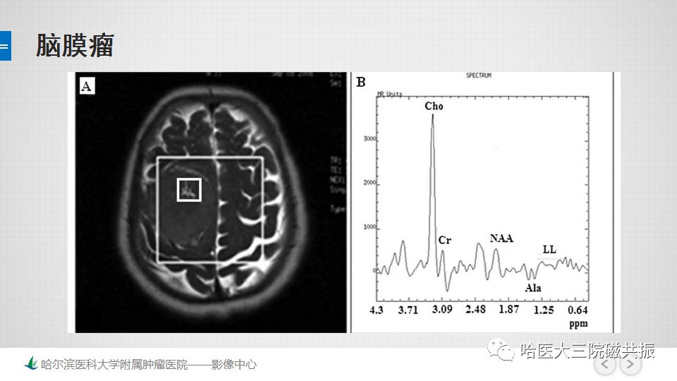 影像PPT - 【PPT】磁共振波谱（MRS）的那些事-34