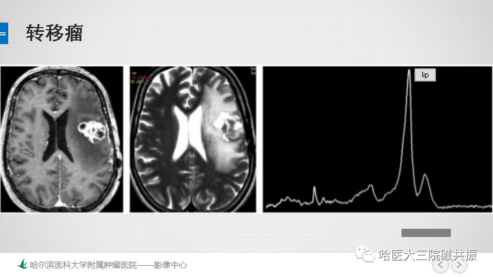 影像PPT - 【PPT】磁共振波谱（MRS）的那些事-35